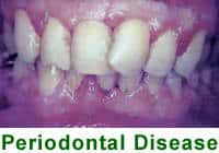 periodontaldisease