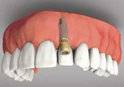 longwood dental implant longwood