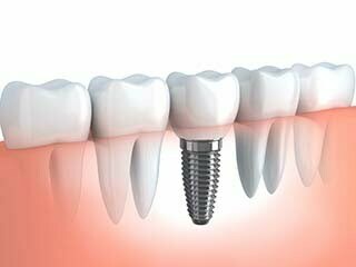 Altamonte Springs dental implants