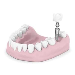dental implants Altamonte Springs Florida