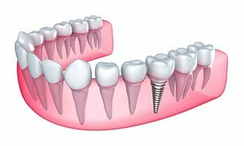 dental implants Longwood Florida