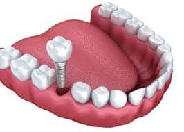 Maitland dental implants