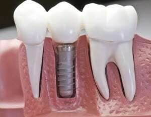 Longwood dental implants
