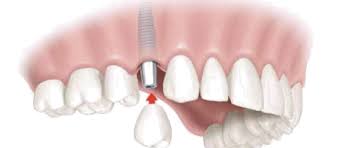 dental implants Maitland Florida