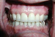 Full porcelain crowns