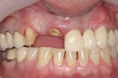 Customized cast post cemented into broken tooth. A new, full porcelain bridge was fabricated to replace the broken and missing teeth
