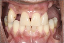 Complete Restorative of upper teeth with a new porcelain bridge and a specialized partial denture, to optimize cosmetics