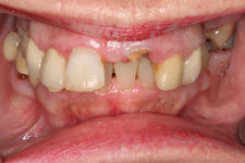 Extractions, root canals, porcelain-fused to metal crown and bridge work