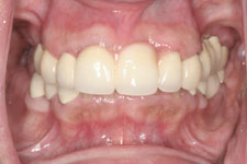Extractions, root canals, porcelain-fused to metal crown and bridge work