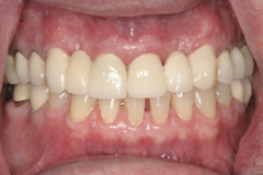 Customized cast post cemented into broken tooth. A new, full porcelain bridge was fabricated to replace the broken and missing teeth