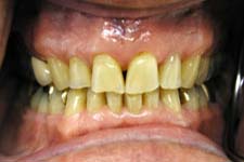 Full porcelain crowns