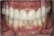Complete Restorative of upper teeth with a new porcelain bridge and a specialized partial denture, to optimize cosmetics