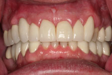 Full Porcelain and Porcelain-fused to Metal crown and Bridge work