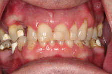 Full Porcelain and Porcelain-fused to Metal crown and Bridge work