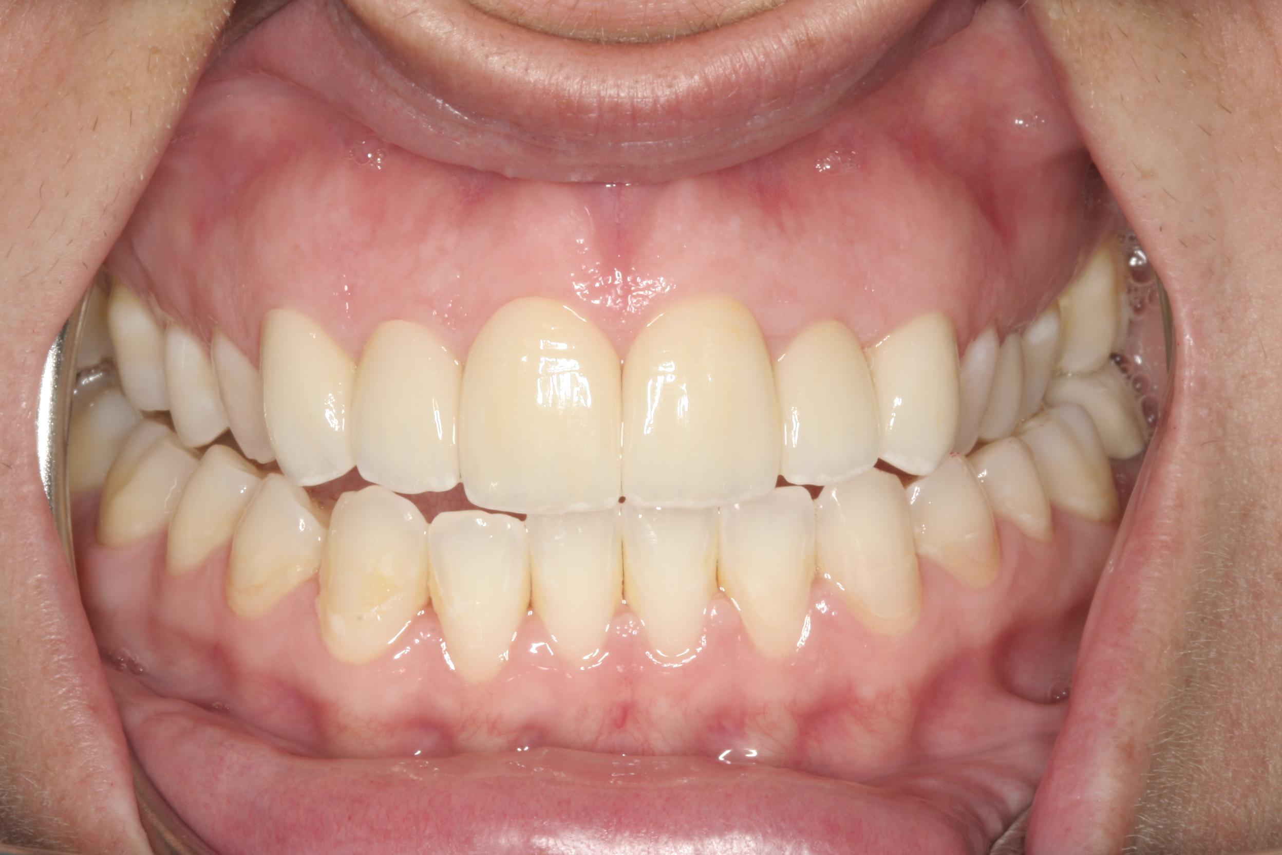 After Veneers