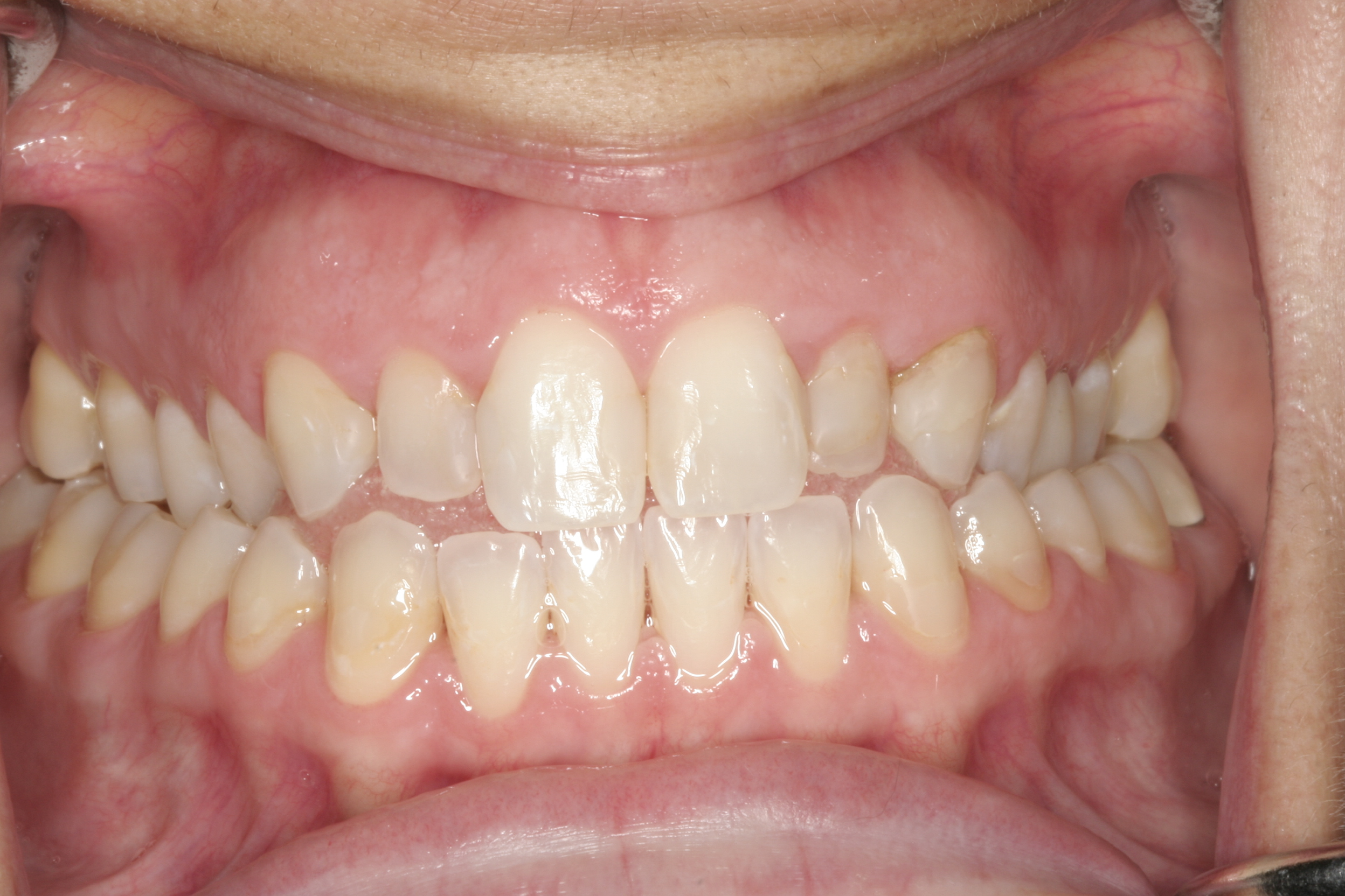Before Veneers