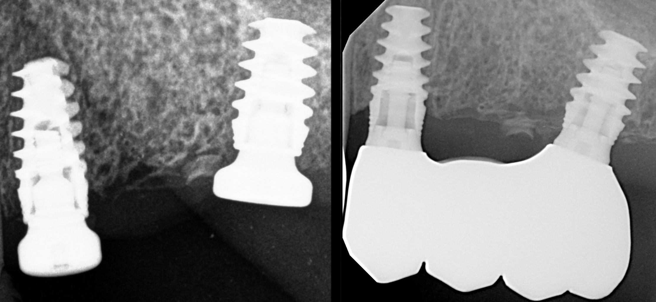 implant