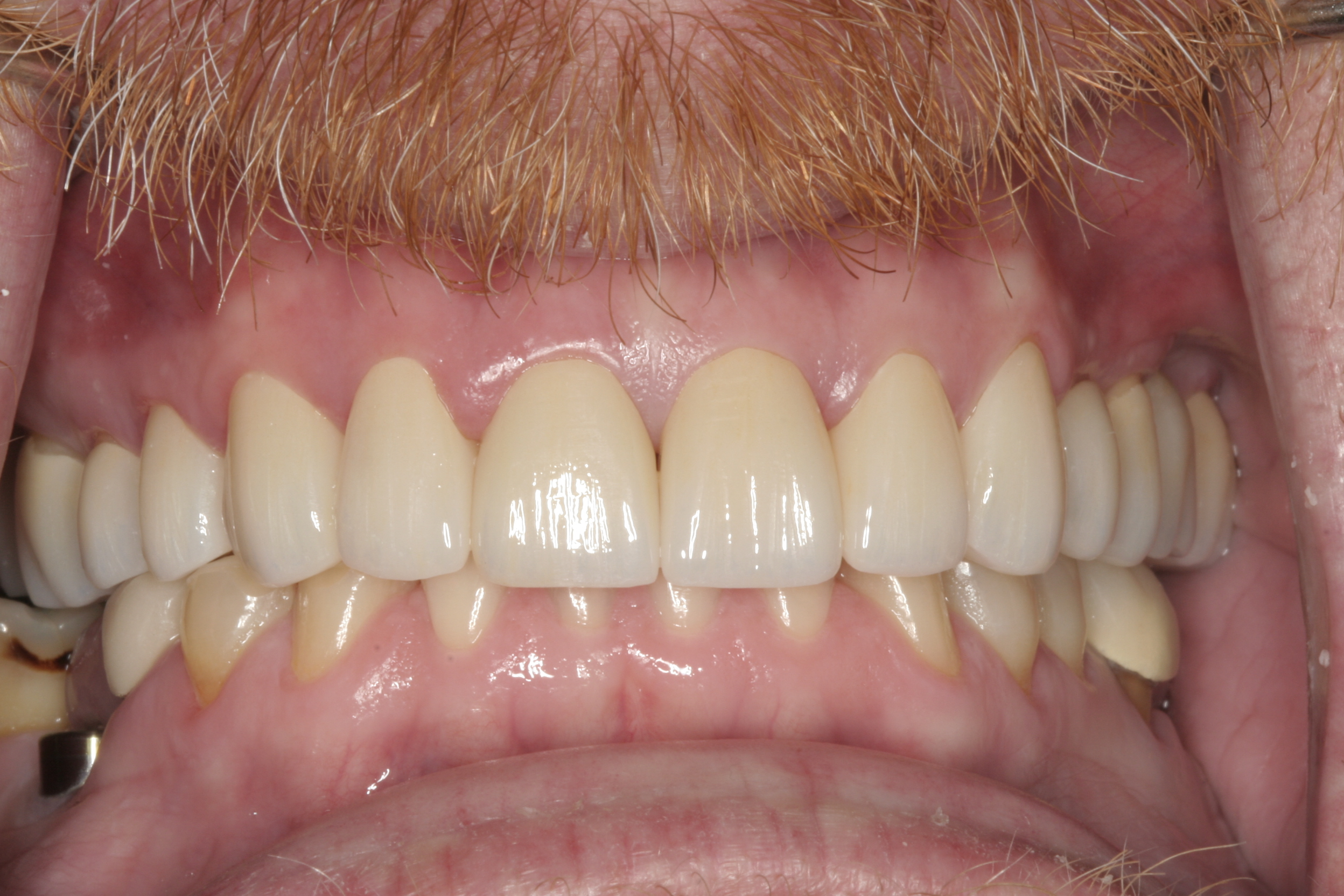 Individual Full Zirconia Crowns