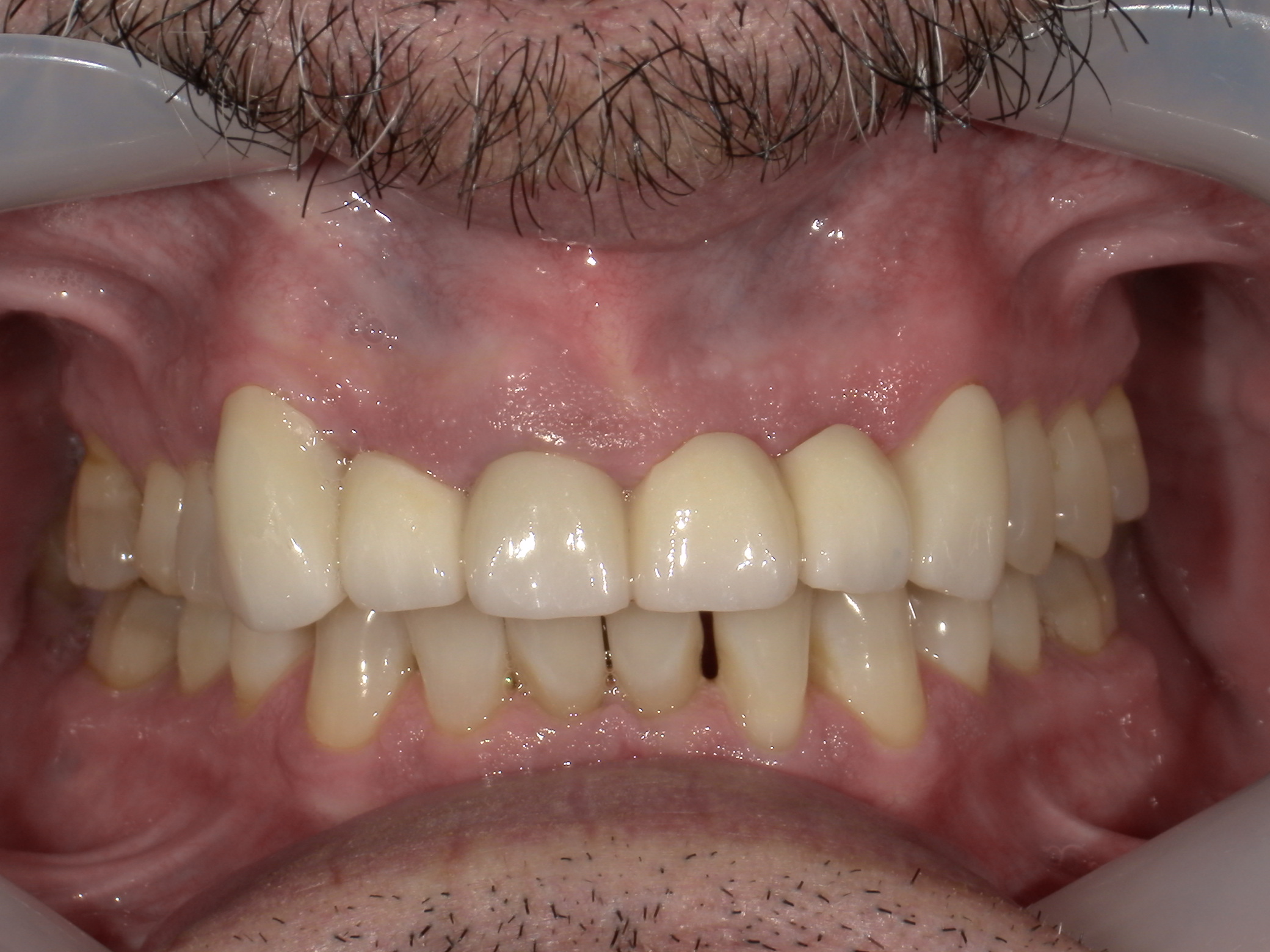 Individual Full Zirconia Crowns