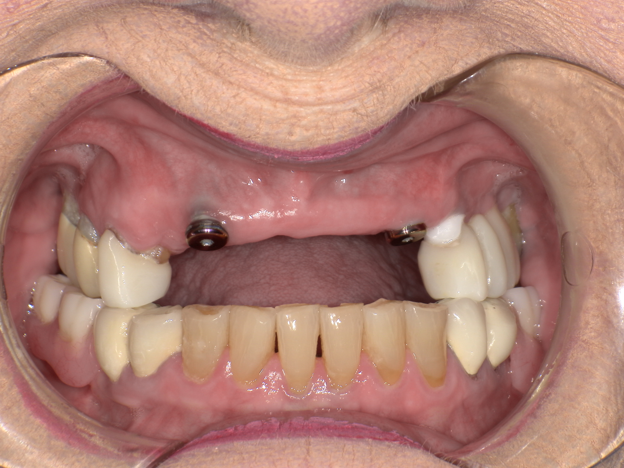 Complete Restorative of upper teeth with a new porcelain bridge and a specialized partial denture, to optimize cosmetics