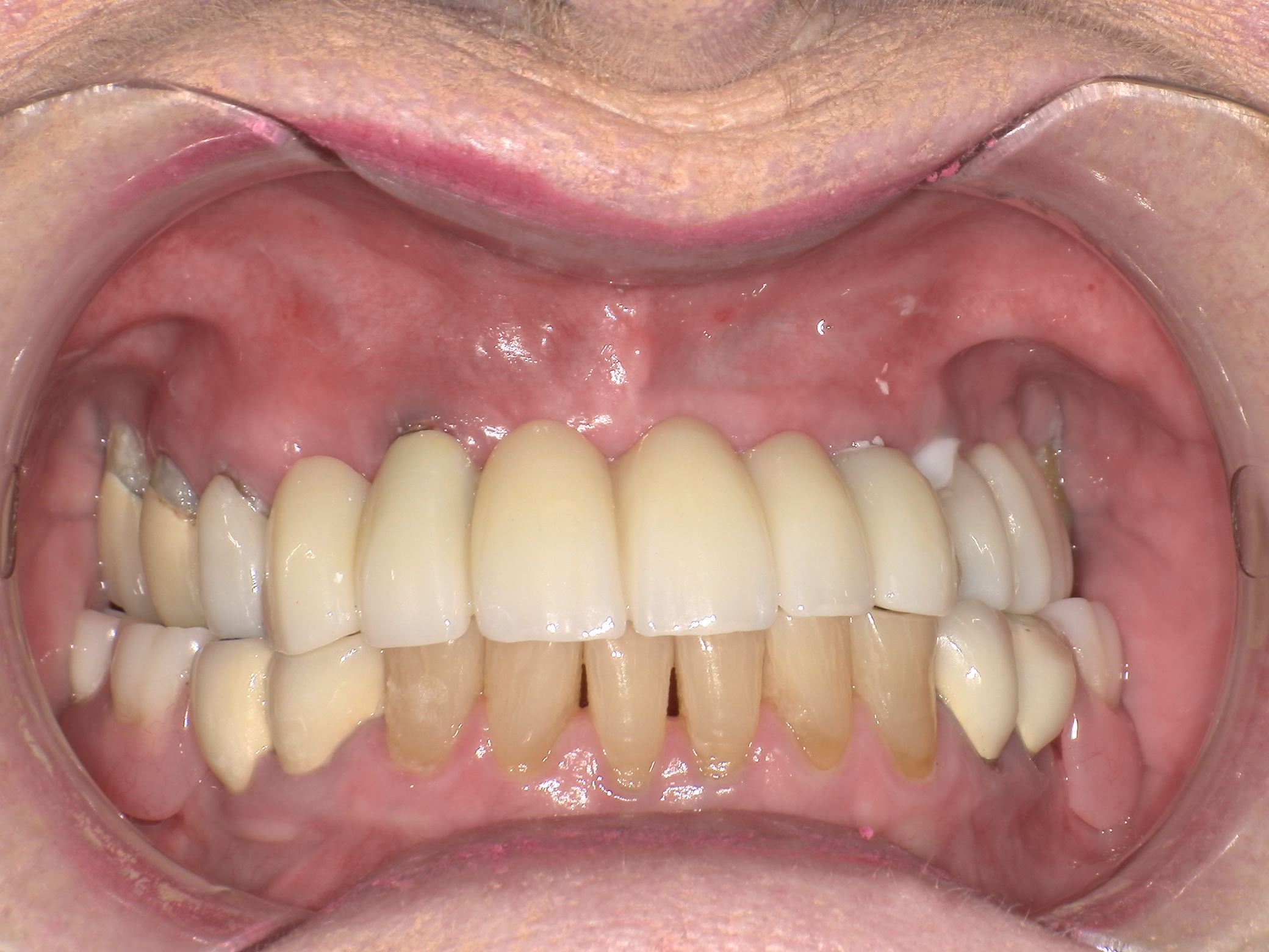 Complete Restorative of upper teeth with a new porcelain bridge and a specialized partial denture, to optimize cosmetics