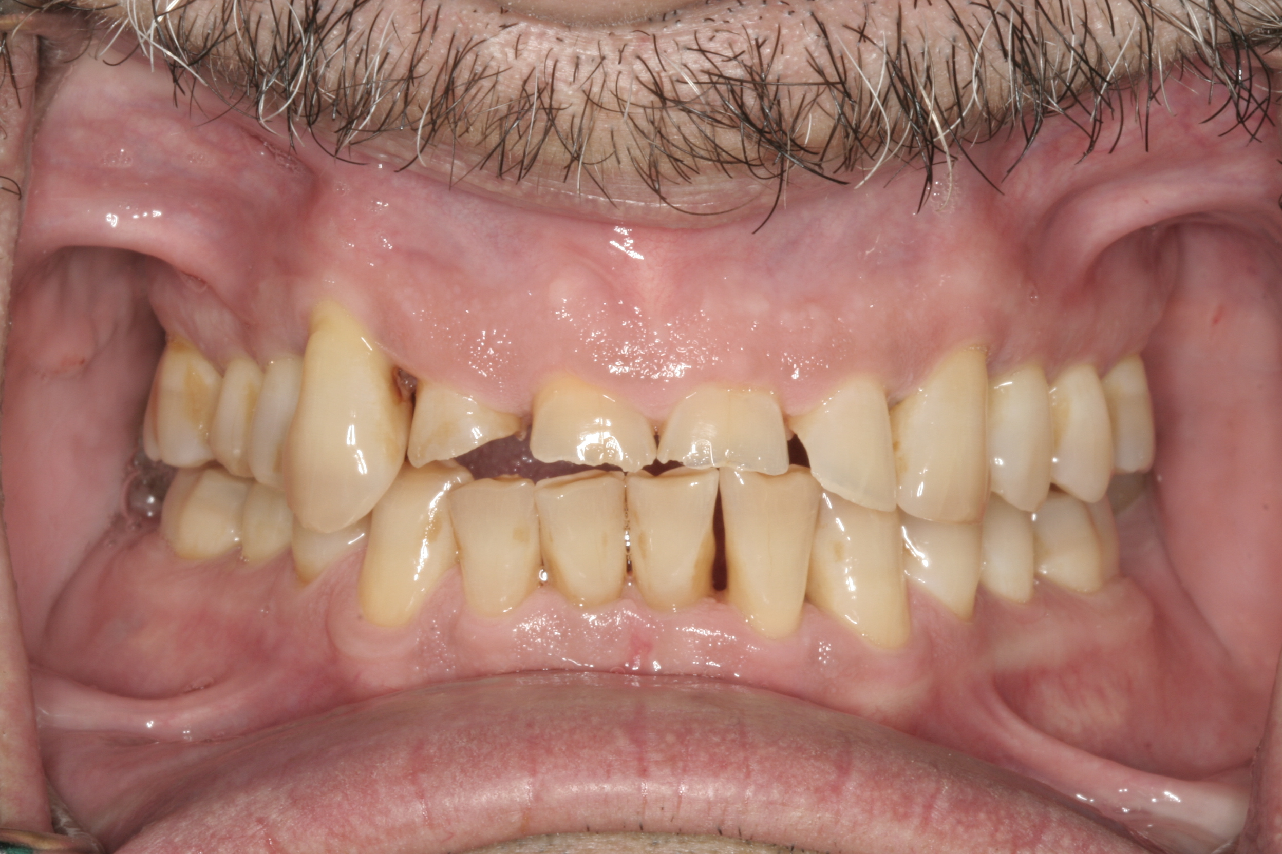 Individual Full Zirconia Crowns