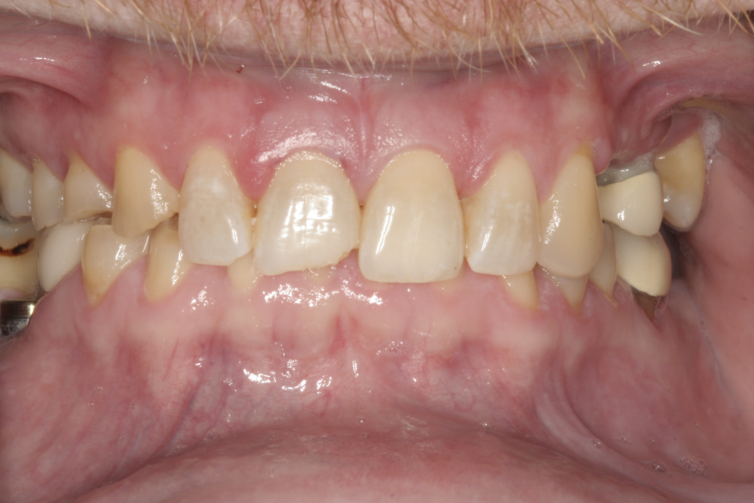 Individual Full Zirconia Crowns